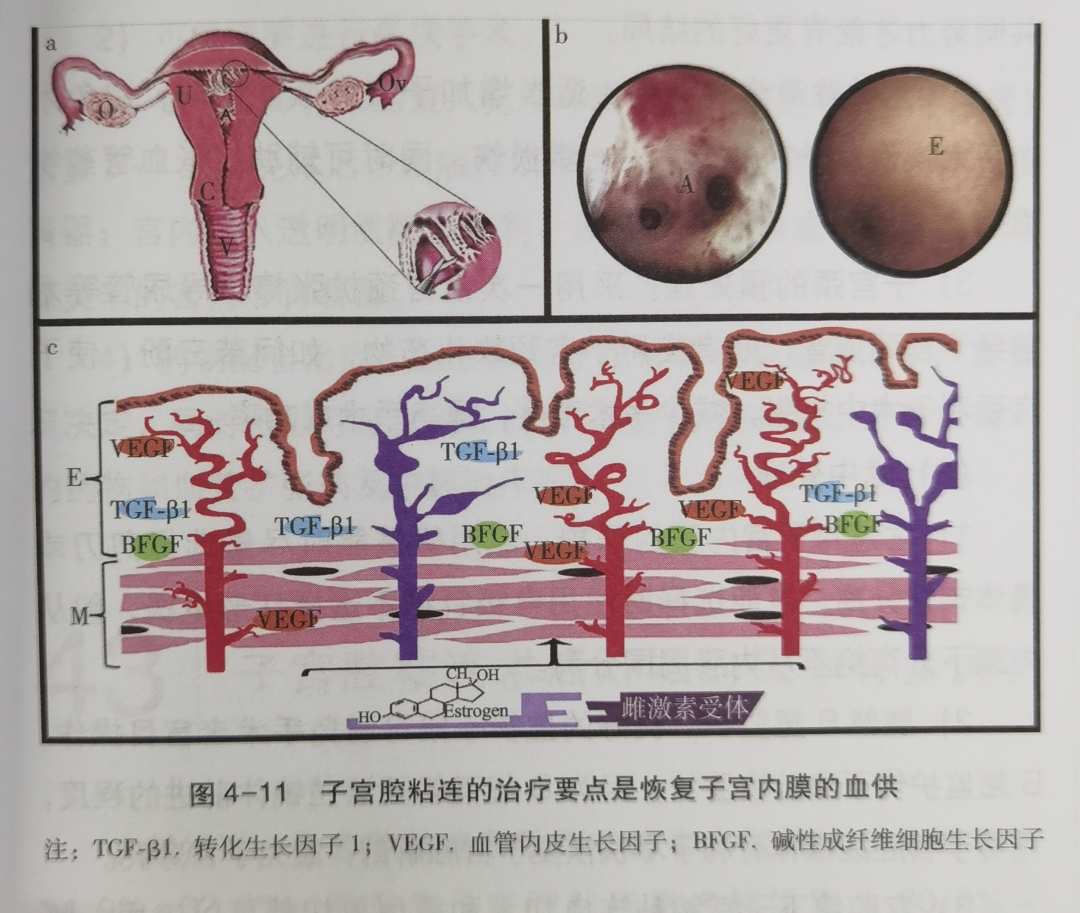 长期放置宫内节育环导致子宫穿孔！专家：过了这个时间必须复查！_张女士